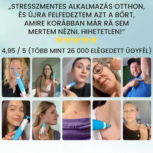 Professzionális szemölcseltávolító készülék – minden bőrtípusra alkalmas