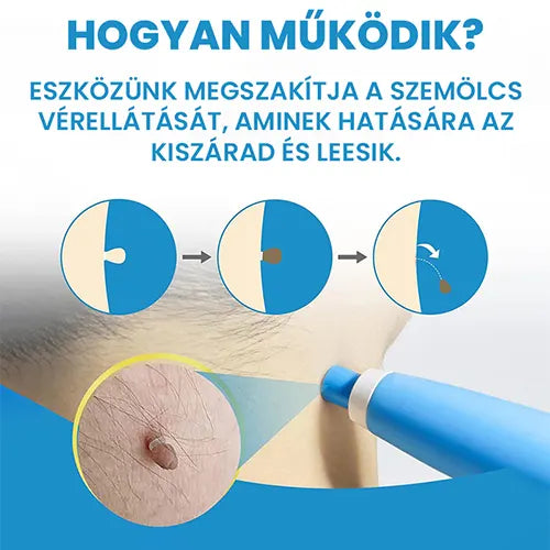 Professzionális szemölcseltávolító készülék – minden bőrtípusra alkalmas