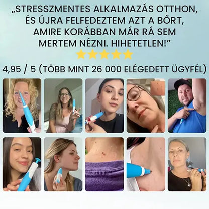 Professzionális szemölcseltávolító készülék – minden bőrtípusra alkalmas